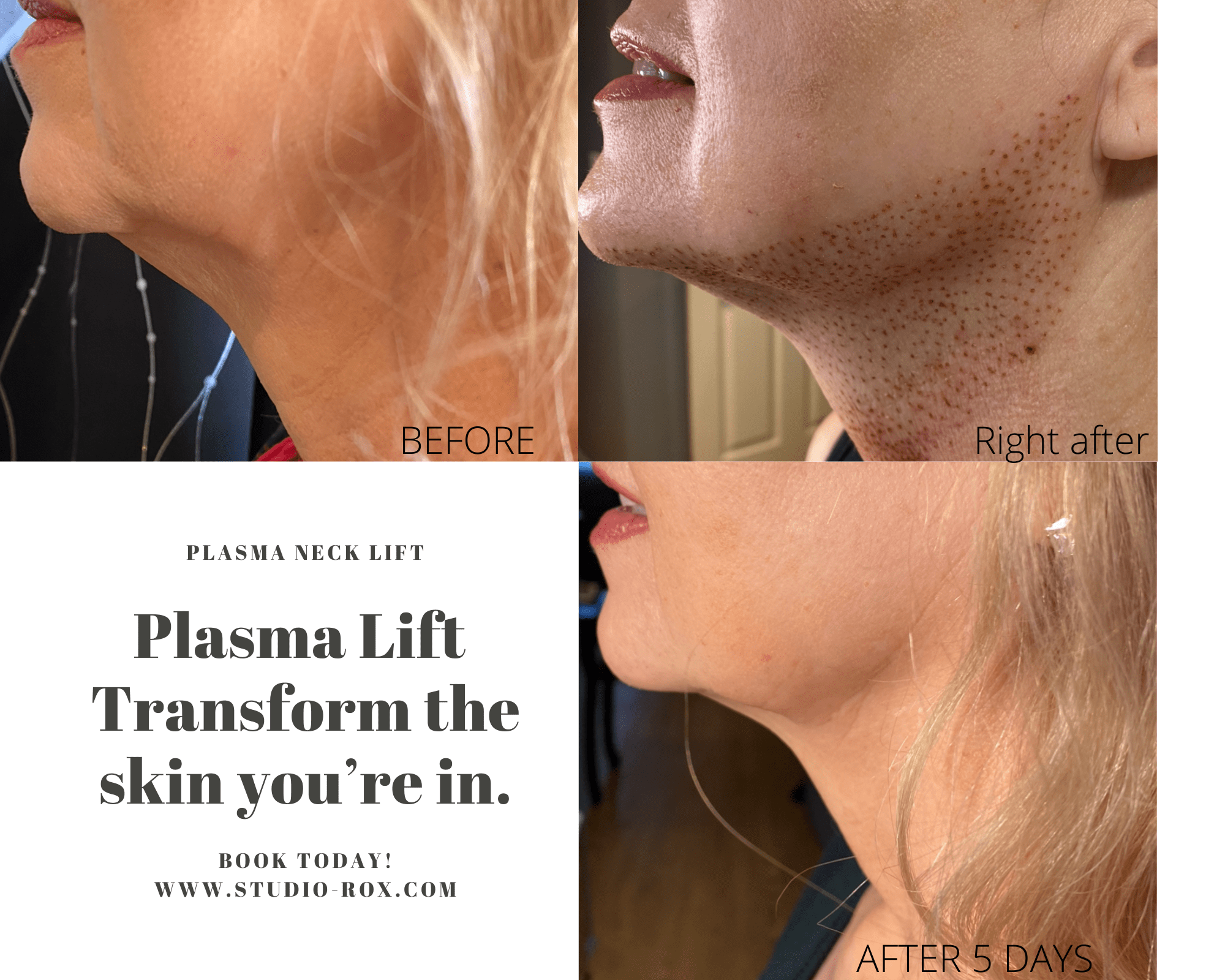 Jowl and Partial Neck Lift 1-min